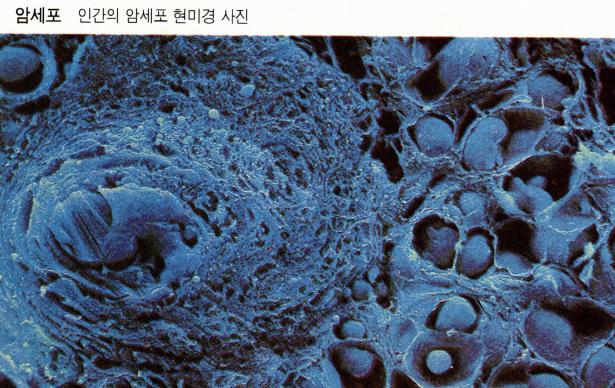 파일:암세포.jpg