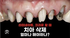 라미네이트치아삭제량.jpeg