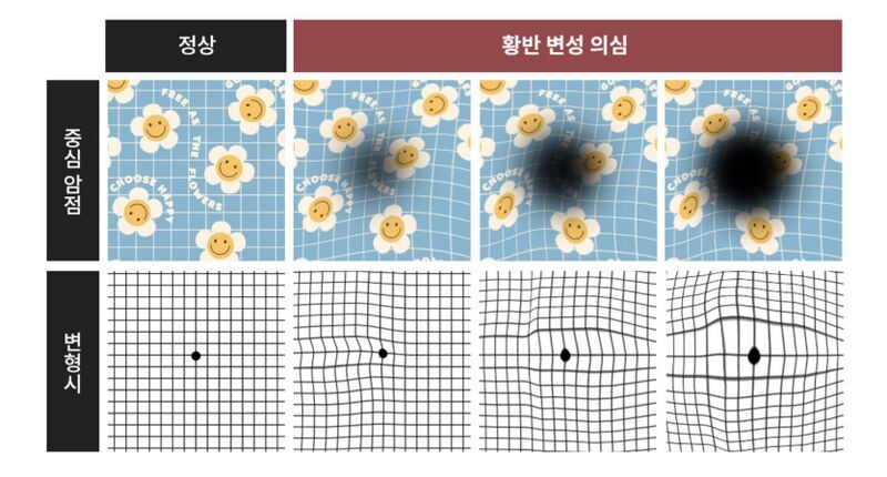파일:황반변성셀프테스트.jpeg